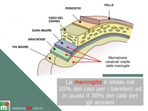 meningite