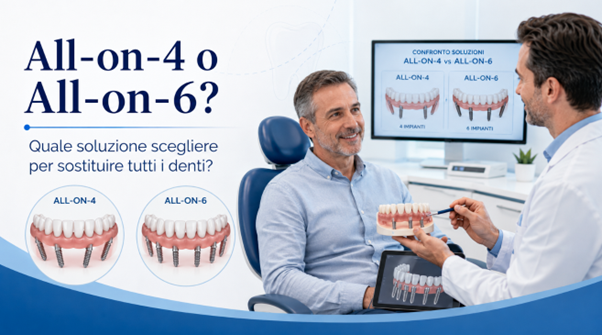 all on 4 o all on 6 quale soluzione scegliere per sostituire tutti i denti da Ilprimatonazionale.it all on 4 o all on 6 quale soluzione scegliere per sostituire tutti i denti